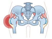 Hip-Bursitis