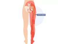 Sciatica