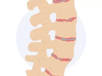 Spondylolisthesis
