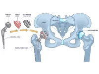 Total-Hip-Replacement