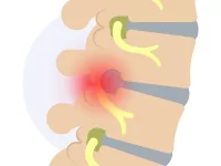herniated-disc